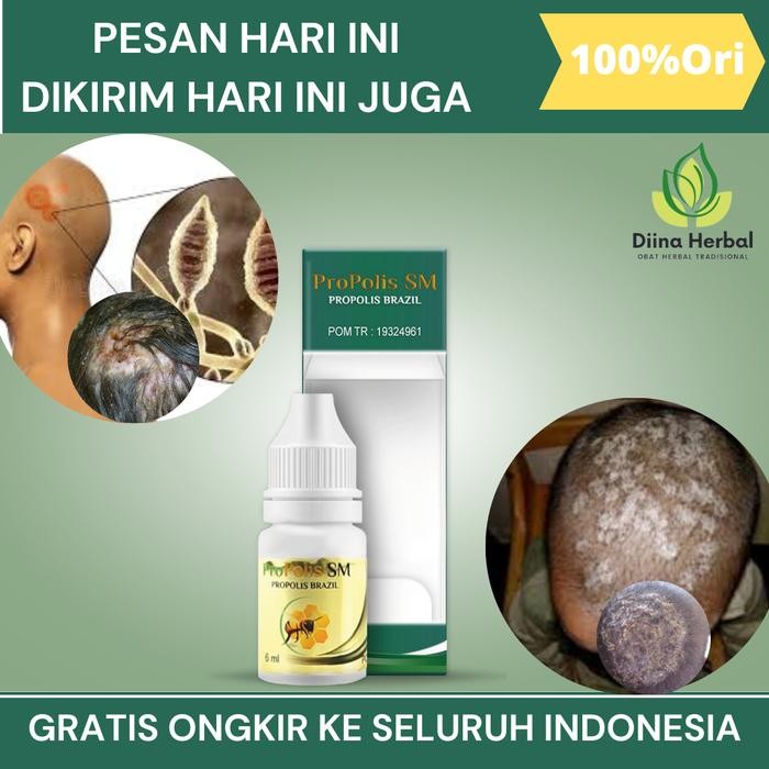 Terbaru Tinea Capitis Di Kulit Kepala, Infeksi Jamur Di Kulit Kepala, Gatal Di Kulit Kepala, Kulit