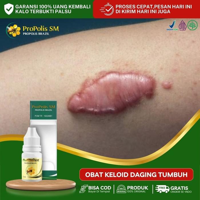 Untuk Penghilang Keloid, Daging Tumbuh, Skin tag di Telinga, Pengempis Keloid Menahun, Keloid