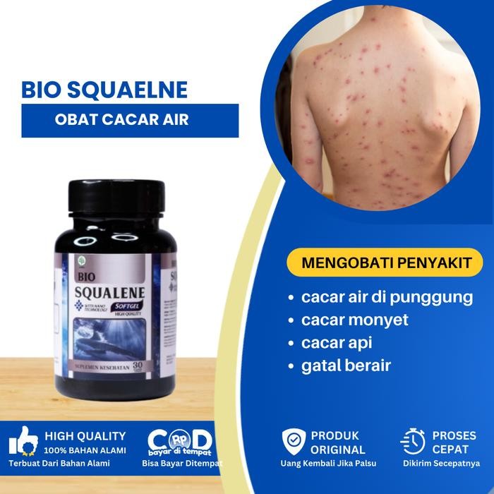 Bio Squalene Mengatasi Cacar Air Di Punggung, Cacar Air, Cacar Monyet, Penghilang Cacar Api, Gatal
