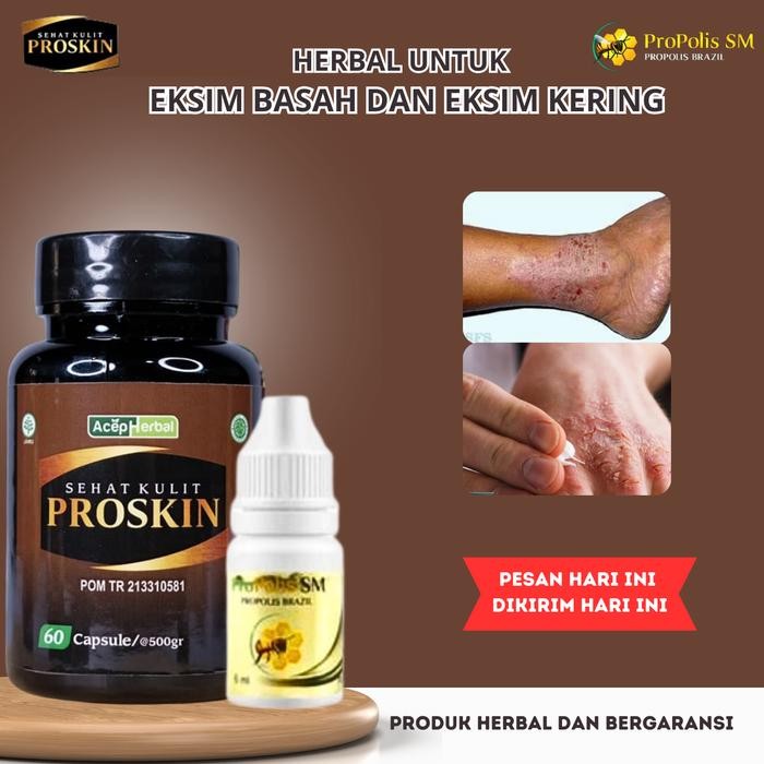 Salep Gatal Eksim Kering Basah Menahun Kurap Kudis Budug Borok Gatal