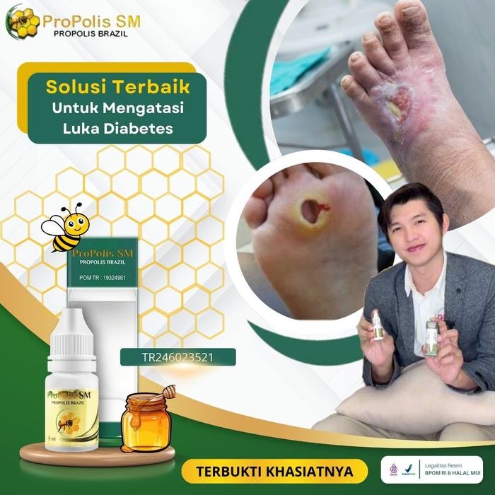 Propolis Untuk Luka Diabetes, Luka Diabetes Kering Luka Diabetes Basah Luka Diabetes Bernanah