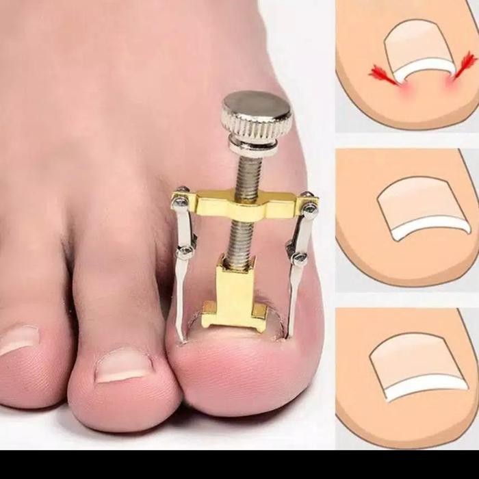 alat terapi kuku cantengan