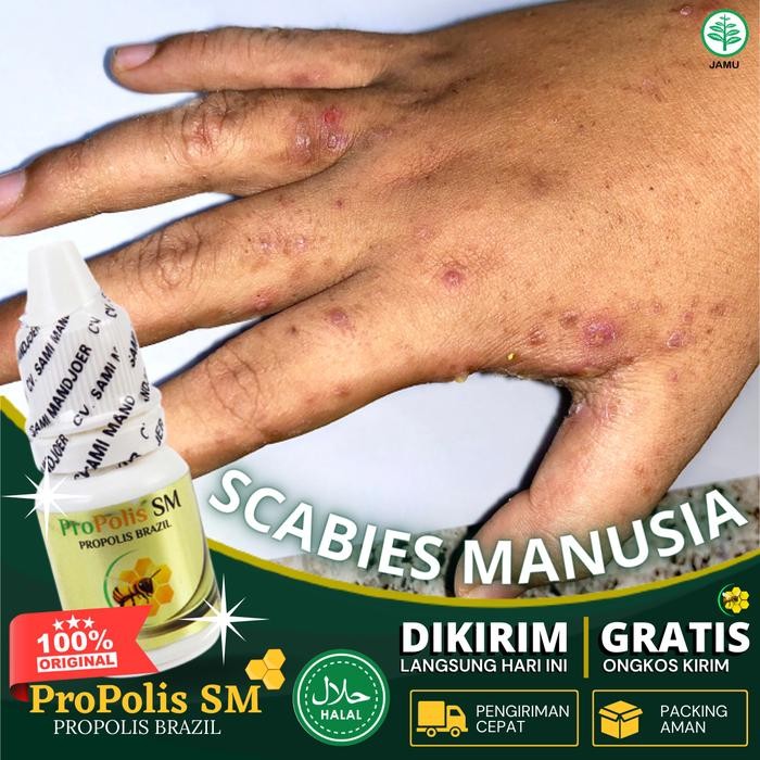 Propolis SM Salep Budug Bernanah, Atasi Penyakit Santri, Gudik Scabies Manusia, Cenang, Borok, Gatal
