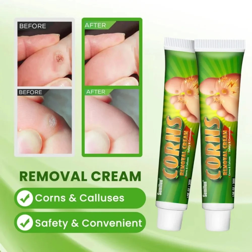 30g Foot Corn Remover Cream Chicken Eye Skin Infection Treatment Ointment Feet Dead Skin Calluses