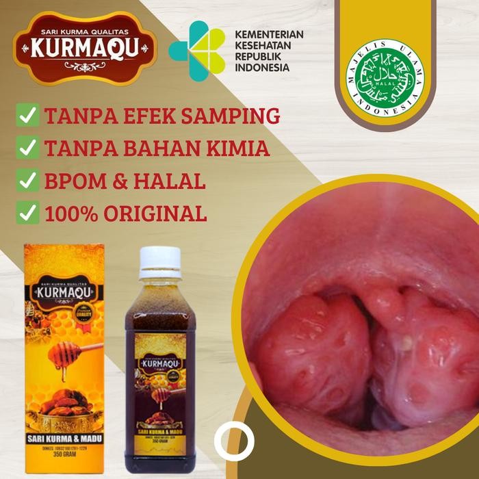 

Sale Solusi Amandel Anak Dan Dewasa, Amandel Bengkak, Radang Amandel, Susah Nelan, Sakit Menelan,