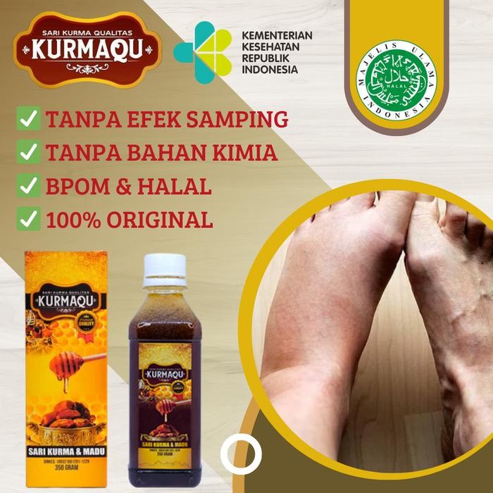 

Sale Kurmaqu - Solusi Bengkak Pada Kaki, Kaki Bengkak & Nyeri, Madu Buat Kaki Bengkak, Kaki Bengak