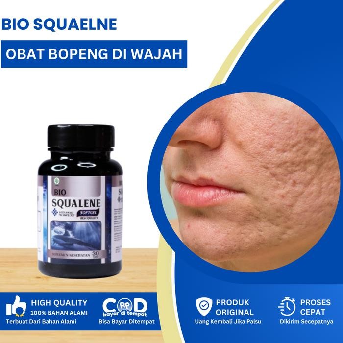 Bio Squalene Mengatasi Bopeng Di Wajah, Bopeng Menahun, Bopeng Berlubang, Untuk Bekas Luka Bopeng Di
