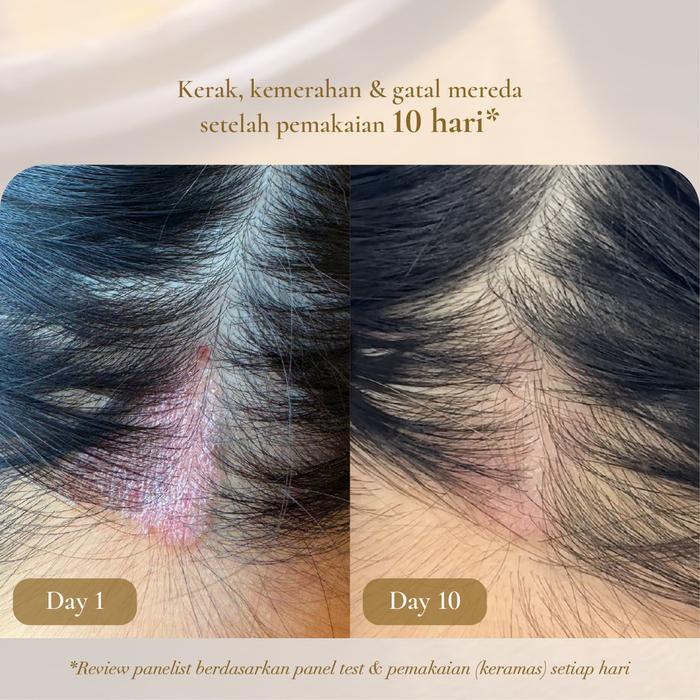 Felaufee - Dandruff Treatment Serum Shampoo - Bundle Anti Ketombe Equiscalp Technology -