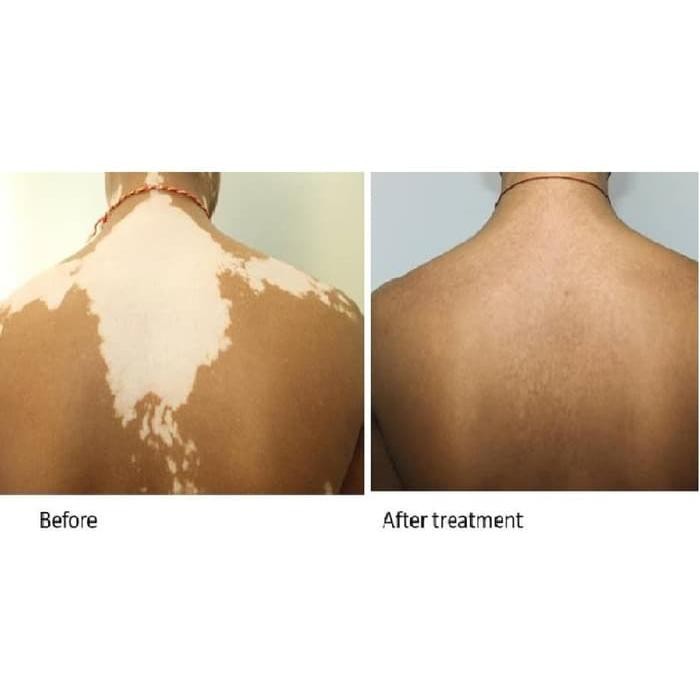 PREMIUM Lampu Vitiligo Psoriasis Fototerapi Narrowband UVB 311nm 2*20 Watt