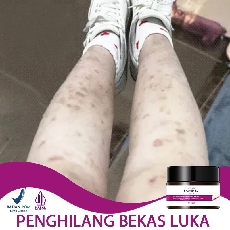 Penghilang bekas luka hitam koreng cream penghilang bekas luka salep luka bakar obat koreng 30g