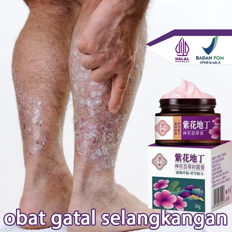Salep gatal salep china gatal paling ampuh obat gatal obat eksim salep gatal selangkangan 30g Obat