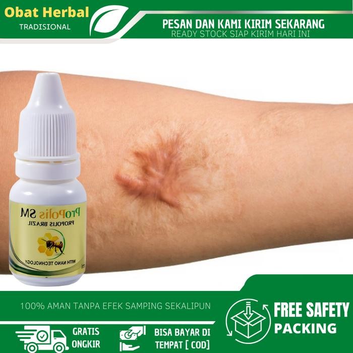 Cairan Oles Penghilang Keloid, Penghilang Daging Tumbuh, Keloid Bekas Operasi, Keloid Luka Tindik Di