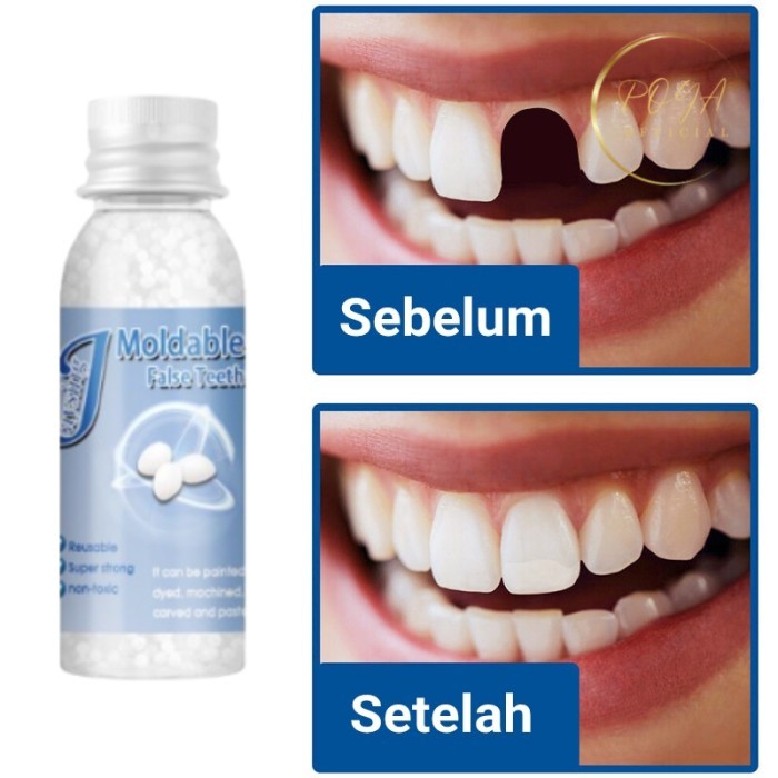 Gigi Palsu Penambal gigi berlubang Gigi palsu asli dokter permanen