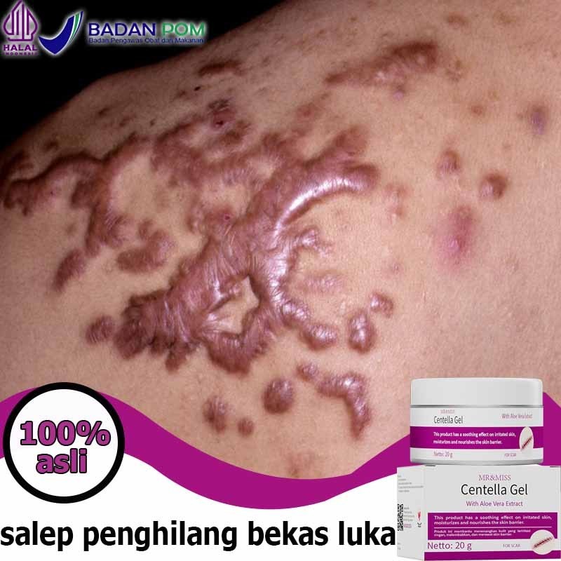 Salep penghilang bekas luka Penghilang bekas luka hitam koreng Obat penghilang bekas luka Bio herbal