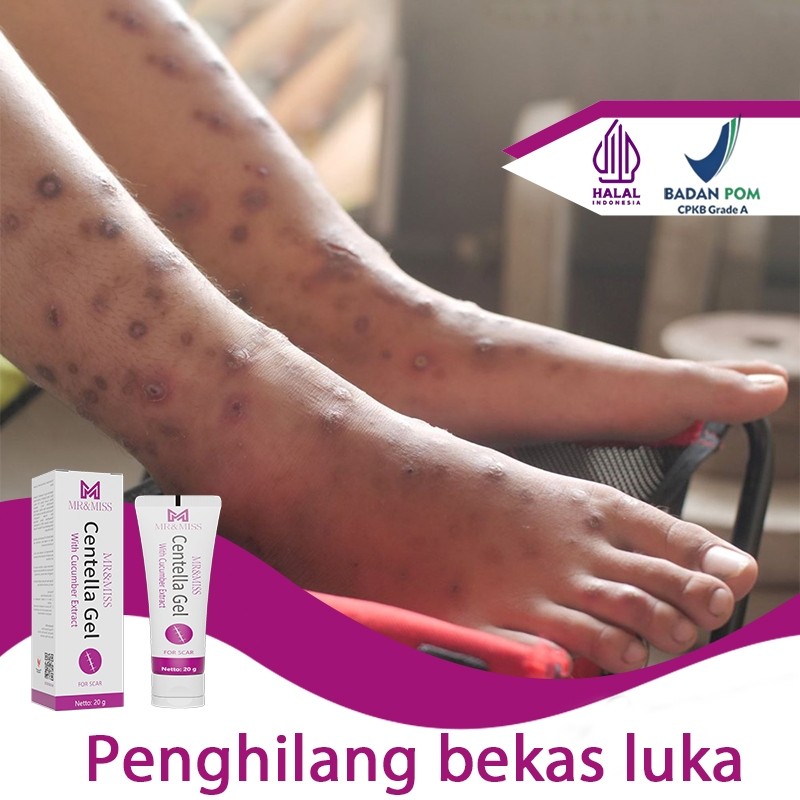Salep penghilang bekas luka hitam koreng penghilang bekas luka anak obat keloid 20g Obat penghilang