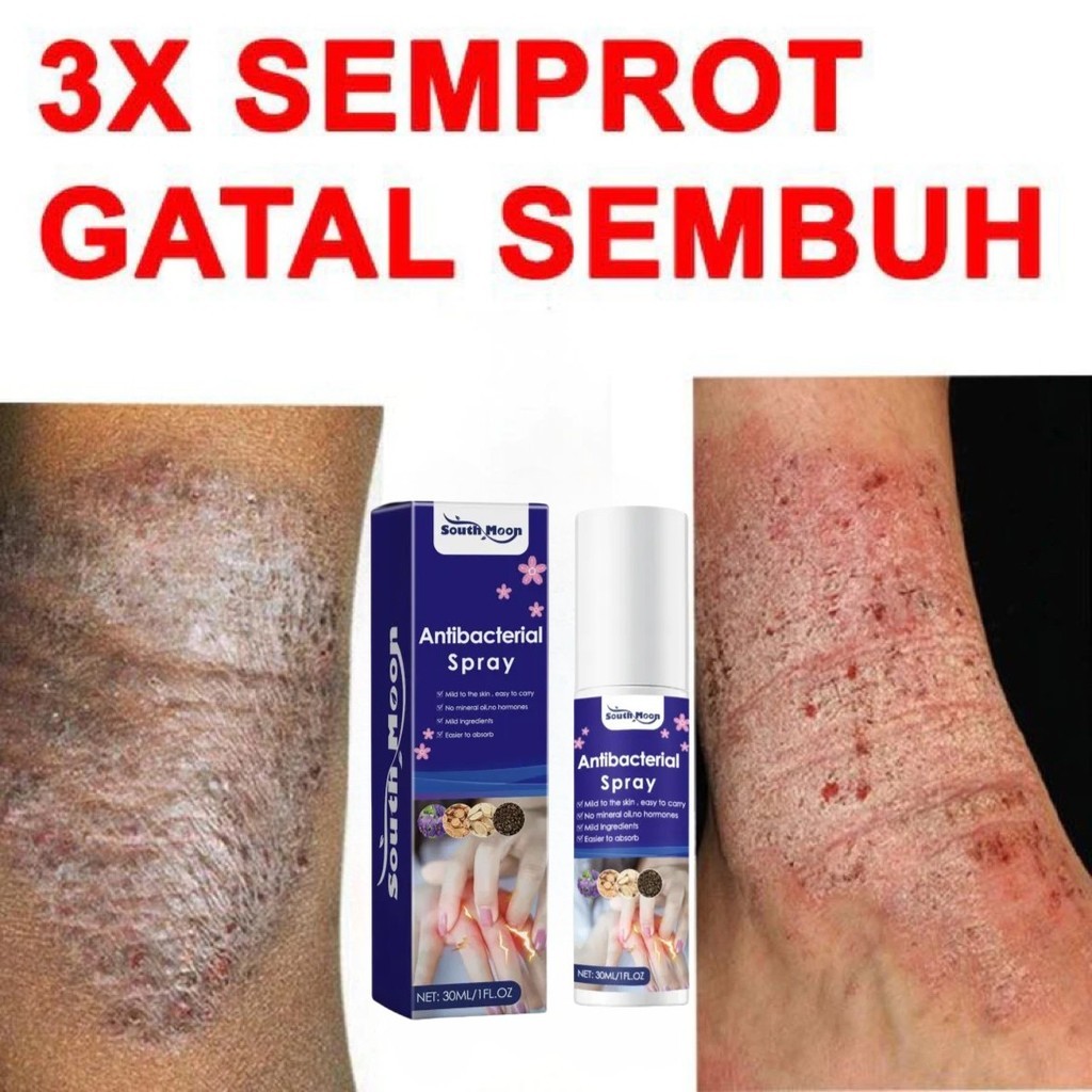 100% OriginalSalep gatal paling ampuh Obat psoriasis obat gatal salep kutil Obat Gatal Salep gatal