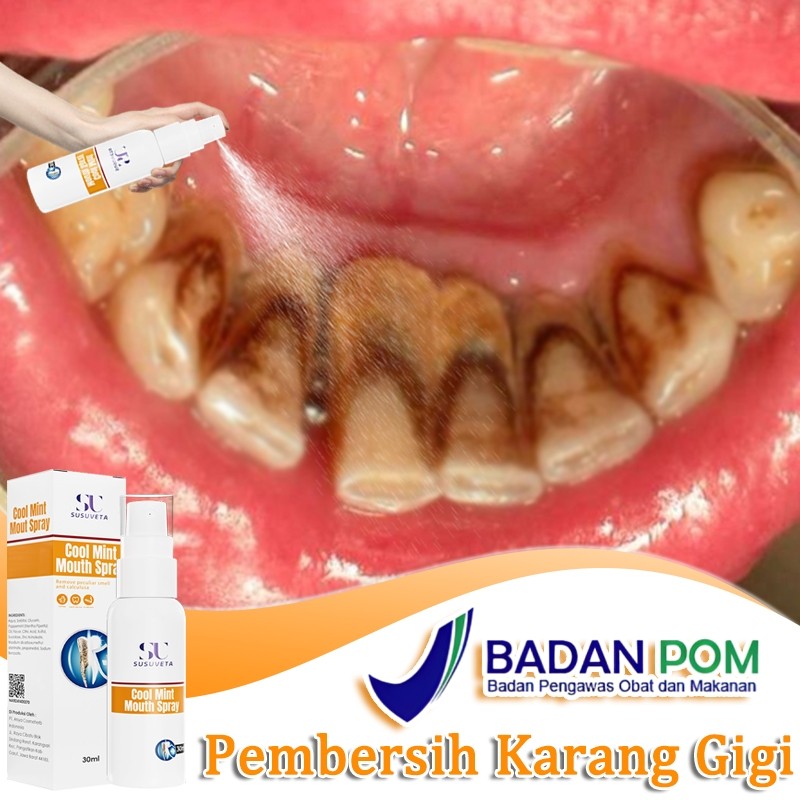 Pembersih Karang Gigi Pembersih Gigi Kuning Dan Karang Perontok Karang Gigi 30ml Penghilang Karang