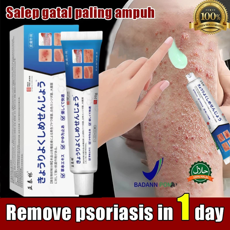 Japan Salep Khusus Psoriasis Obat Gatal Eksim Krim psoriasis paling ampuh Kulit Kepala Psoriasis
