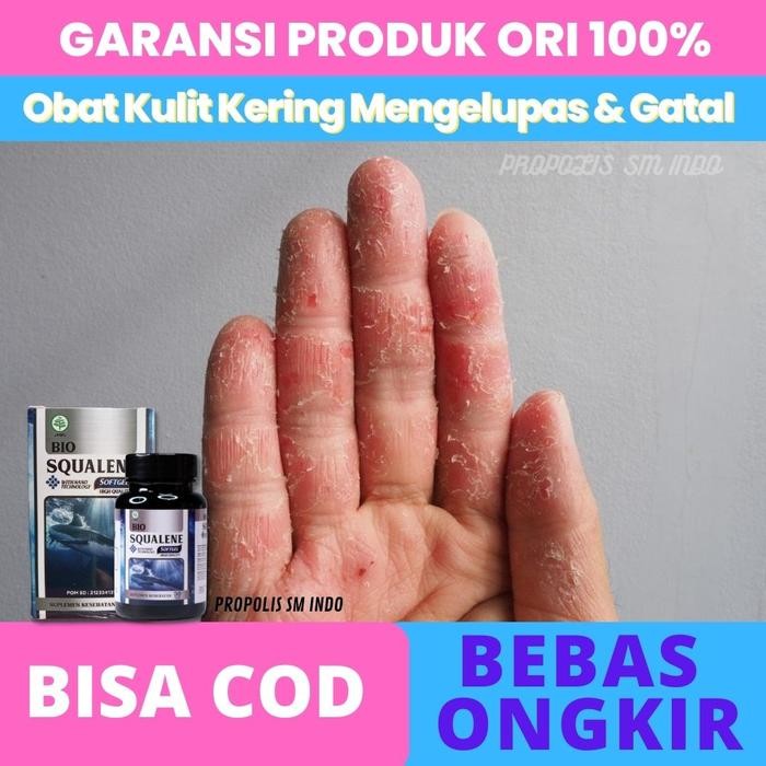 terjaminDiKita- Obat Kulit Jari Tangan Kering Mengelupas dan Gatal, Psoriasis Herbal