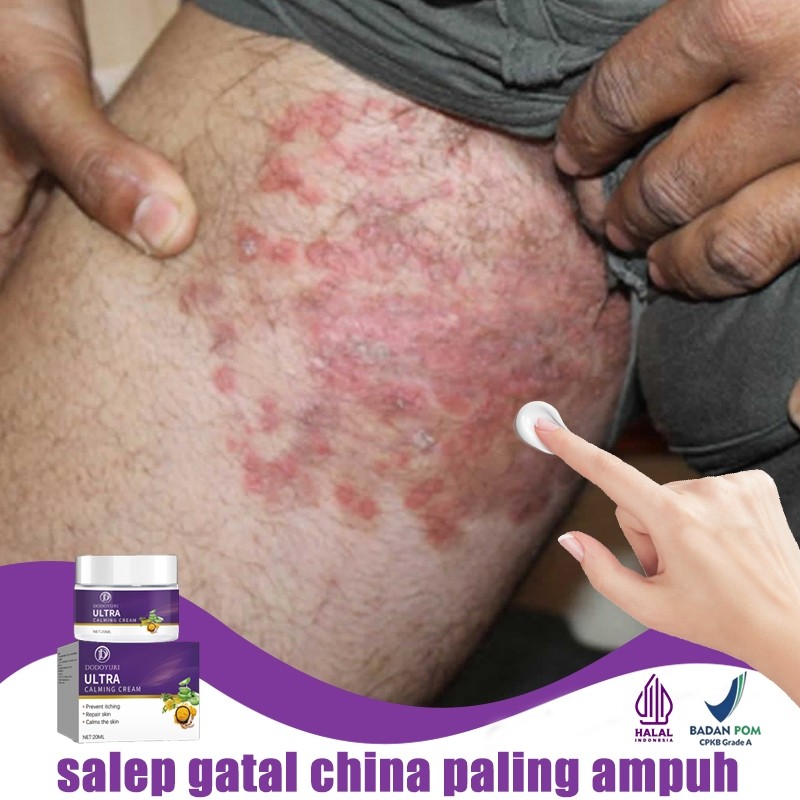 Salep gatal salep china gatal paling ampuh obat gatal obat eksim salep gatal selangkangan 20g Obat