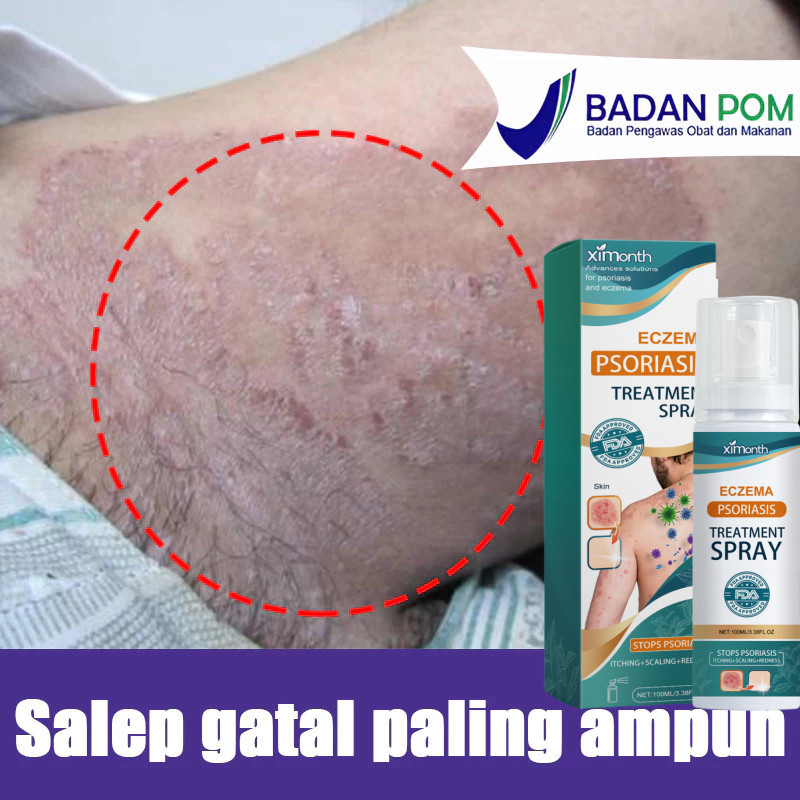 Salep gatal paling ampuh Obat psoriasis obat gatal salep kutil Obat Gatal Salep gatal Salep