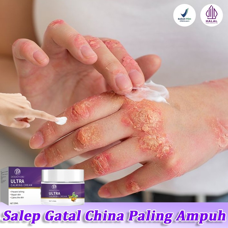 Obat gatel Obat gatal gatal Salap gatal kulit yang ampuh Salep gatel 20ml Salep selangkangan gatal