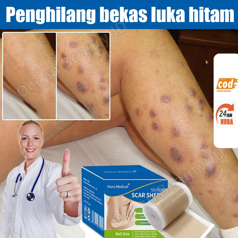 Silicone Scar Sheet Scar Patch Plester Keloid Plester Bekas Luka Keloid Penghilang Bekas Luka