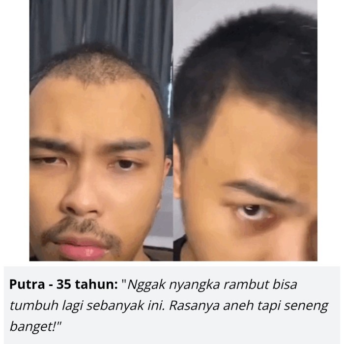 Hair Growth Dht Blocker Serum & Shampoo Penumbuh Rambut Herbal Alami Promo