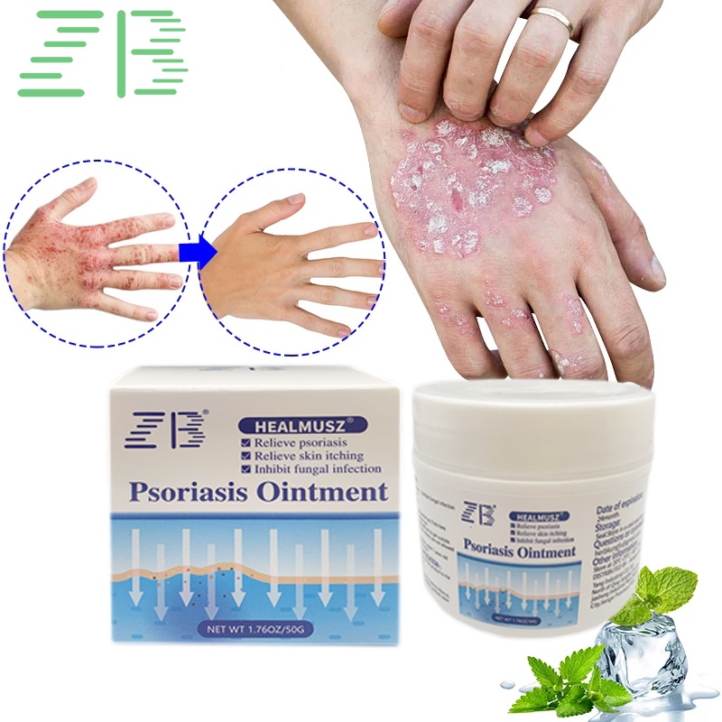 Zb 50G Psoriasis Cream Rash Urticaria Desquamation Treatment Antibacterial Ointment Dermatitis