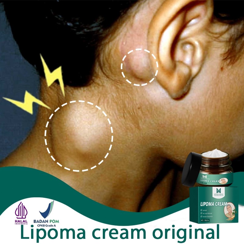 Obat benjolan lipoma cream original lipoma cream obat lipoma 30g lipoma removal cream original salep