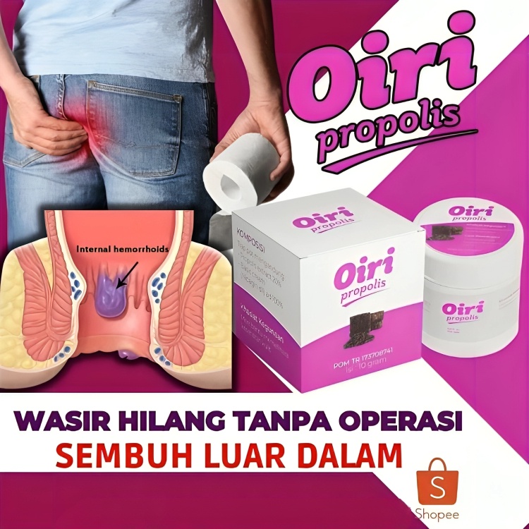Salep Oiri Atasi Wasir Ambeien Stadium 4 Gangguan BAB