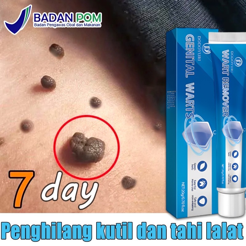 Penghilang kutil dan tahi lalat Obat penghilang tahi lalat Penghilang tahi lalat di wajah Salep