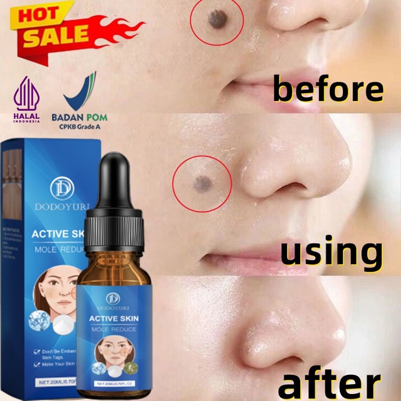 Penghilang tahi lalat penghilang tahi lalat di wajah obat penghilang tahi lalat penghilang tailat