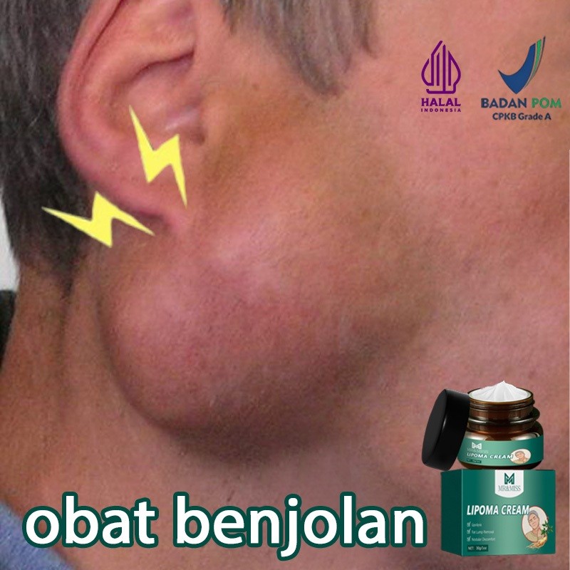Obat benjolan lipoma cream original lipoma cream obat lipoma 30g lipoma removal cream original salep