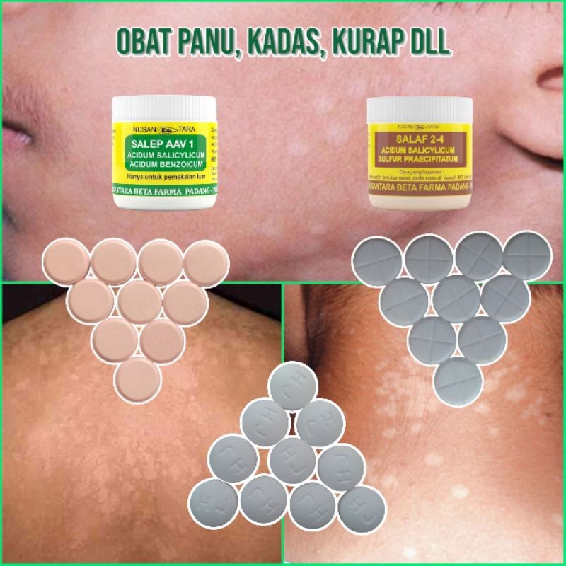 Obat Penghilang Panu Paling Ampuh