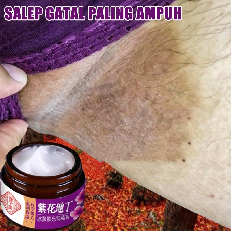 100%OriSalep gatal paling ampuh obat gatal selangkangan obat gatal paling ampuh 30g Salep gatal