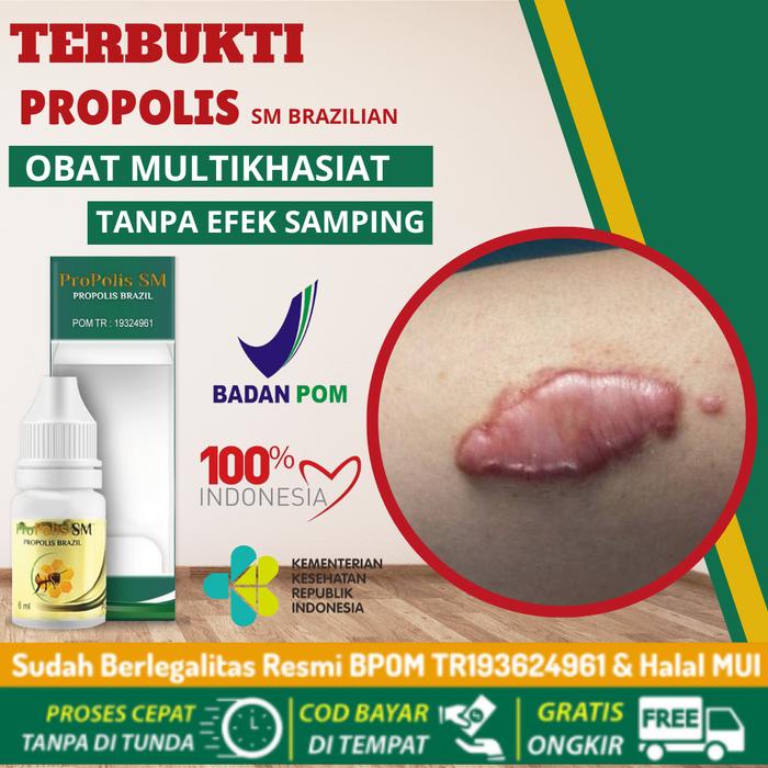 

Propolis SM Penghilang Keloid, keloid Luka Tindik, Keloid Daging Tumbuh, Keloid Menahun