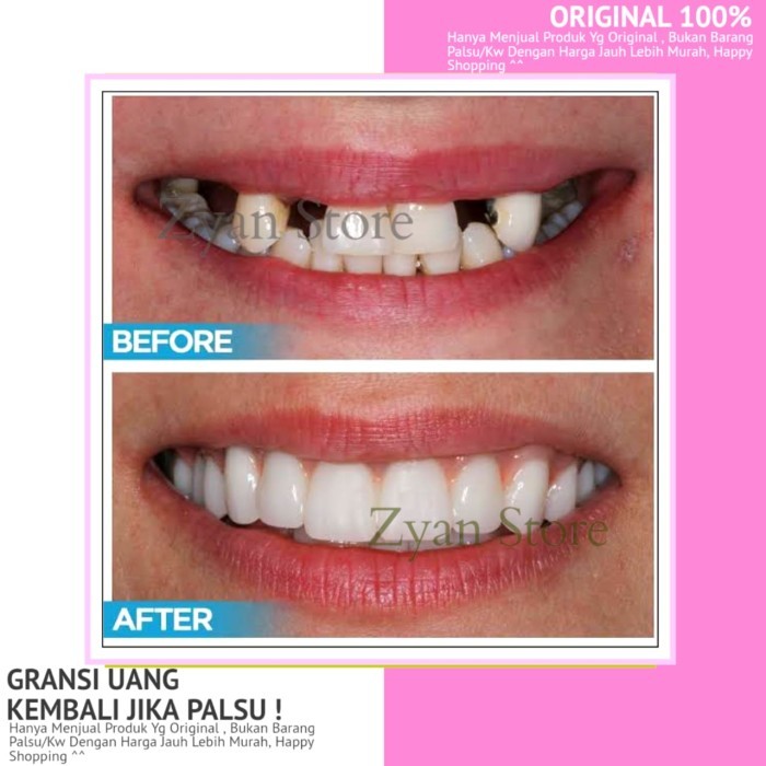 PERMANEN Gigi Palsu Penutup Ompong Depan Penambal Gigi isi 500 butir