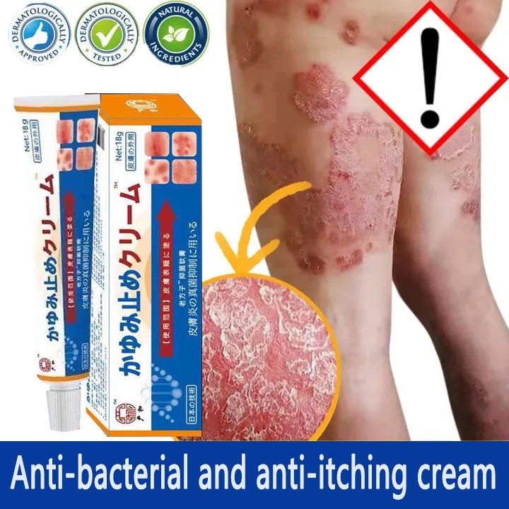 Japan Obat herbal Cina khusus untuk psoriasis membandel, psoriasis, jock itch, salep psoriasissalep