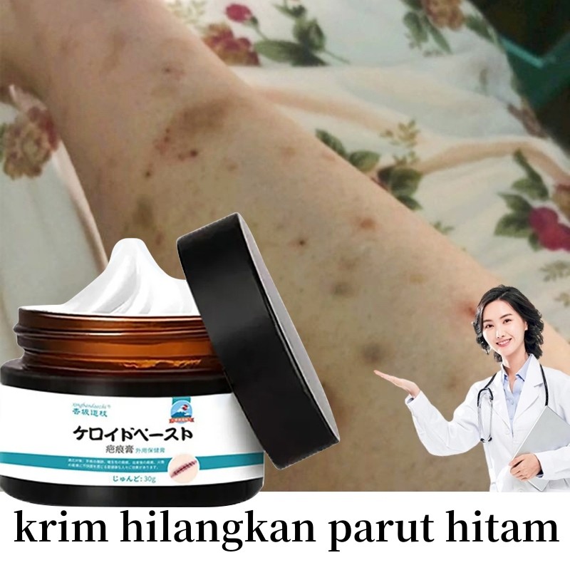 Salep penghilang bekas luka Penghilang bekas luka hitam koreng Penghilang bekas gigitan nyamuk bekas