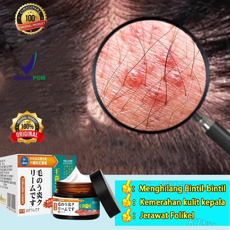{100% asli} obat kepala gatal obat eksim obat psoriasis obat ketombe salep 30g kenazol kenazol