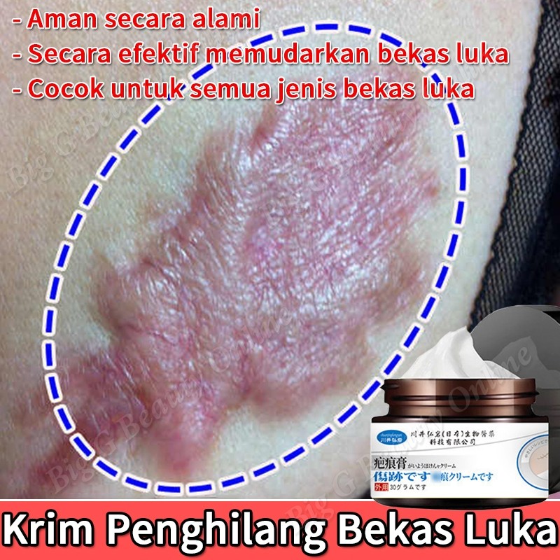 Krim Penghilang Bekas Luka Hitam Koreng Penghilang Bekas Cacar Bekas Luka Kaki Bekas luka Keloid