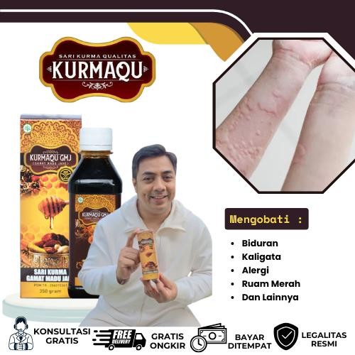 Biduran, Alergi, Kaligata Akut, Gatal-Gatal, Kaligata Menahun, Ruam, Bintik Merah - Kurmaqu