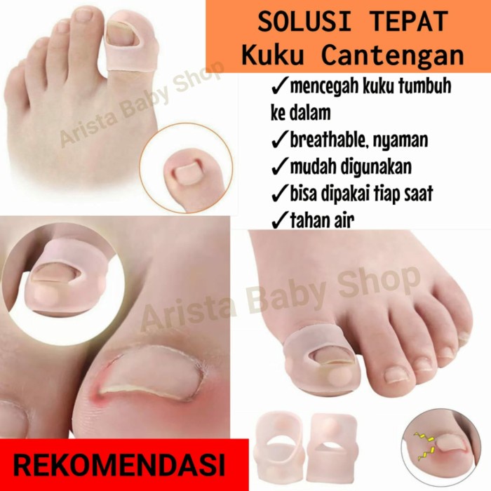 Alat Koreksi Kuku Kaki Tumbuh Ke Dalam Bahan Silikon Elastis Cantengan