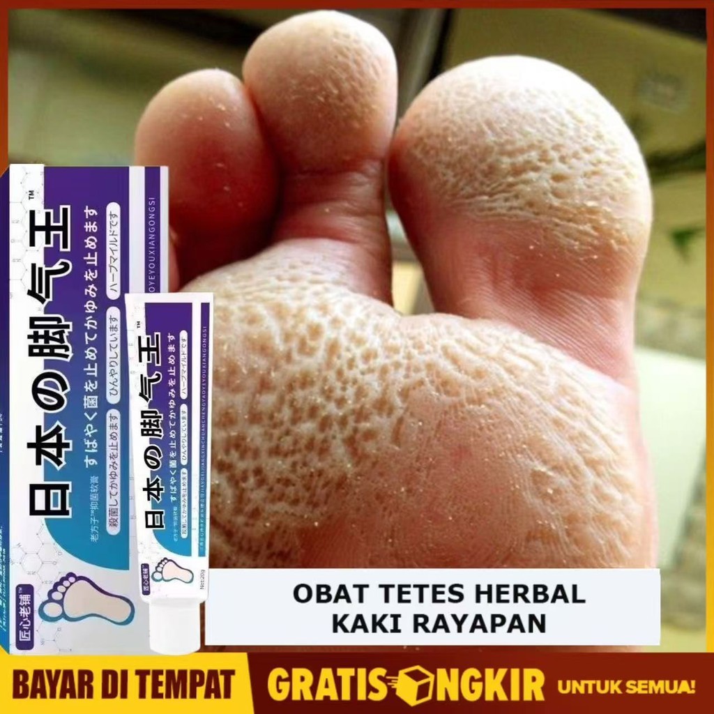 MD Obat Kaki Rayapan dan Bau Obat Kaki Rayapan Penghilang Bau Kaki Obat Kaki Rayapan Paling Salep