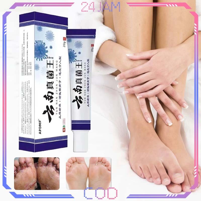 MD Obat Kaki Kapalan Kaki Rayapan Dan Bau Obat Kaki Rayap Salap Kaki Rayapan Efektif Penghilang