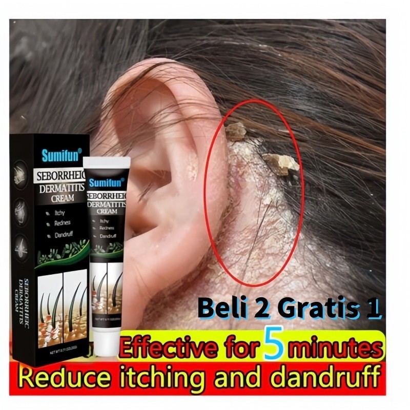 obat krim Borok di Kepala krim Kepala Gatal, Tinea Kapitis,krim Jamur Kulit Kepala krim Dermatitis