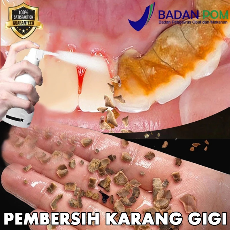 Pembersih karang gigi Penghilang karang gigi 30ml membandel alat pembersih karang gigi Pemutih Gigi
