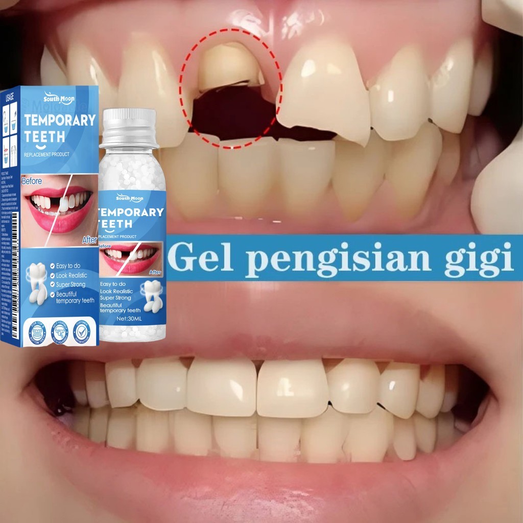 South Moon Penambal Gigi Berlubang Gigi Penambal Gigi Isi Gigi Palsu Penambal Gigi Berlubang Gigi