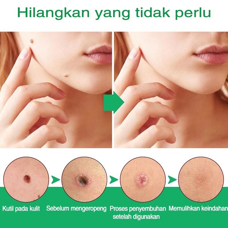 RB22 Obat kutil paling ampuh salep kutil obat kutil di leher penghilang kutil dan tahi lalat 10ml